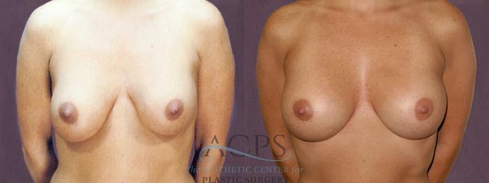 Before & After Breast Revision Case 1068 Front View: View in Houston, TX