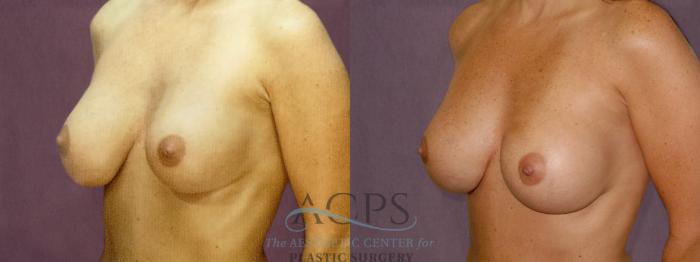 Before & After Breast Revision Case 1068 Oblique Left View: View in Houston, TX