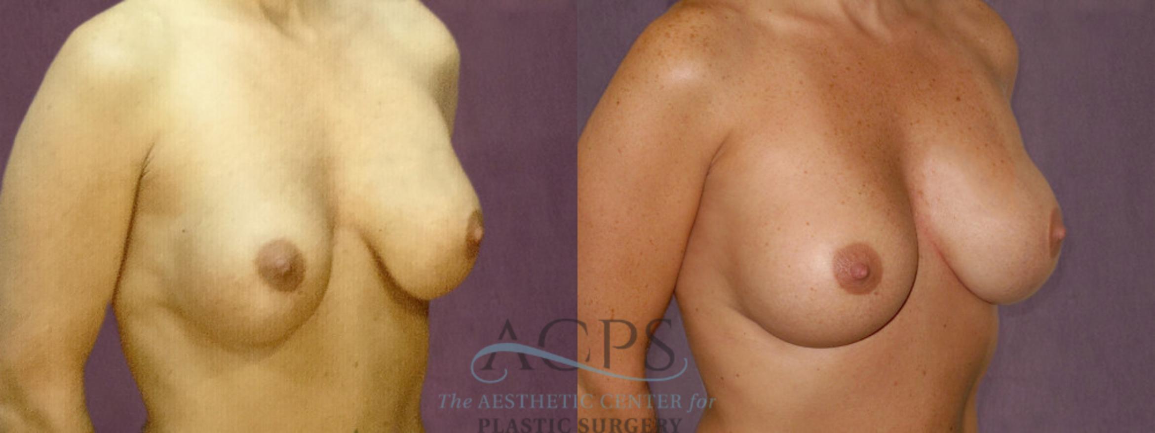 Before & After Breast Revision Case 1068 Oblique Right View: View in Houston, TX