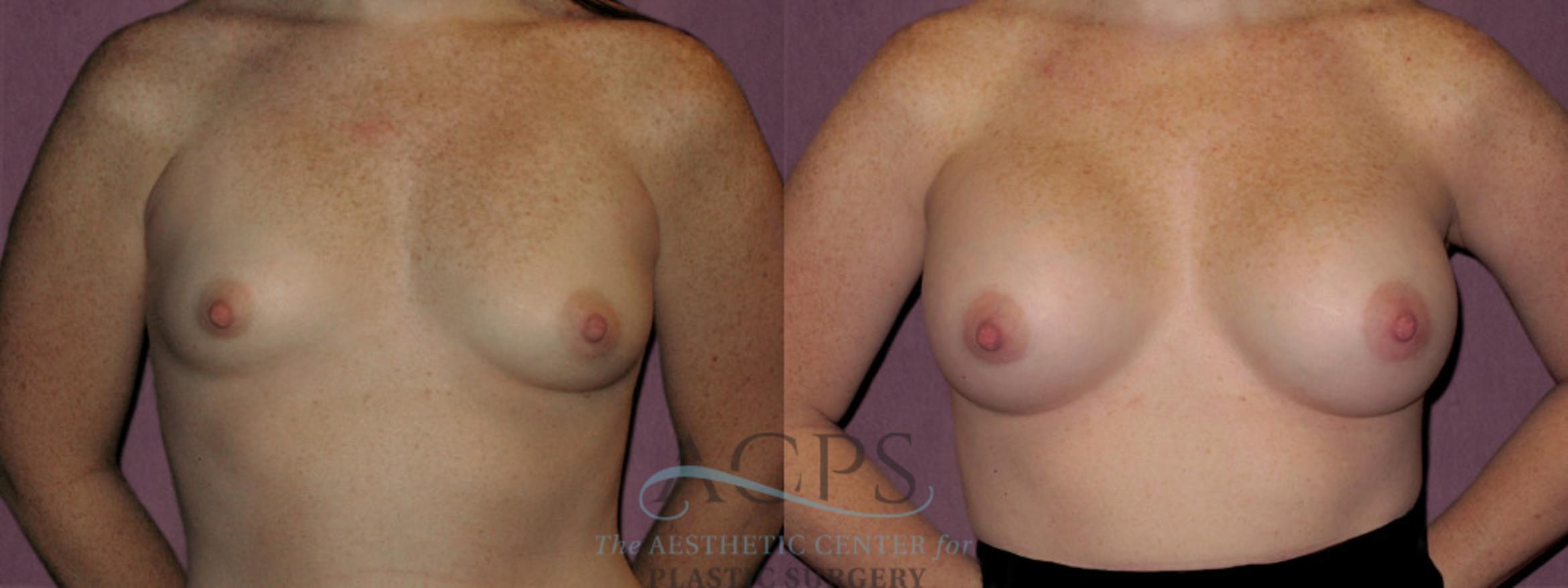 Before & After Breast Revision Case 1069 Front View: View in Houston, TX