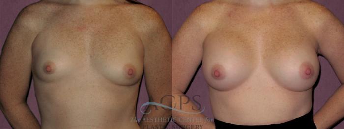 Before & After Breast Revision Case 1069 Front View: View in Houston, TX