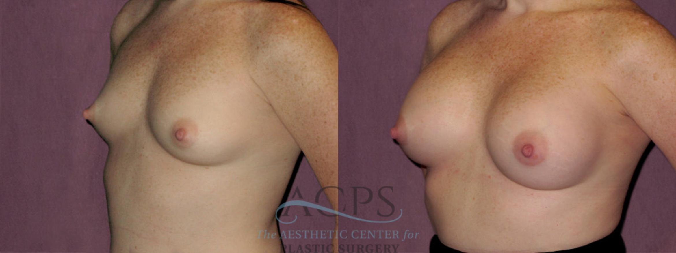 Before & After Breast Revision Case 1069 Oblique Left View: View in Houston, TX