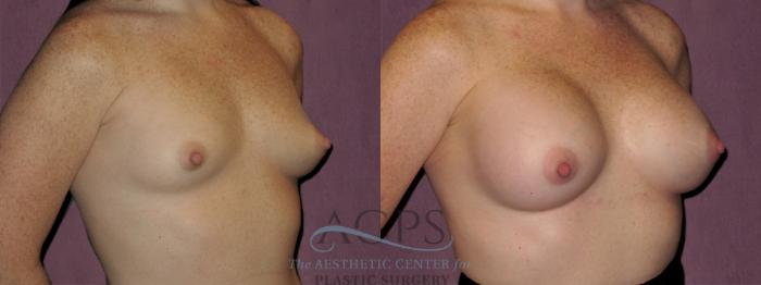 Before & After Breast Revision Case 1069 Oblique Right View: View in Houston, TX