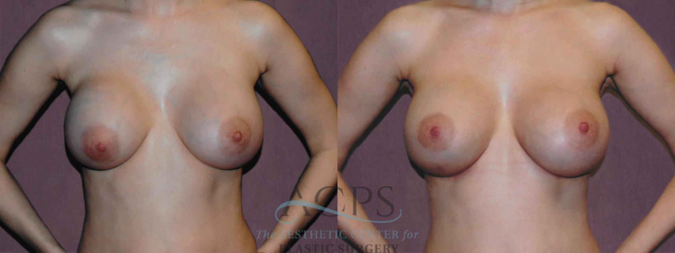 Before & After Breast Revision Case 1070 Front View: View in Houston, TX