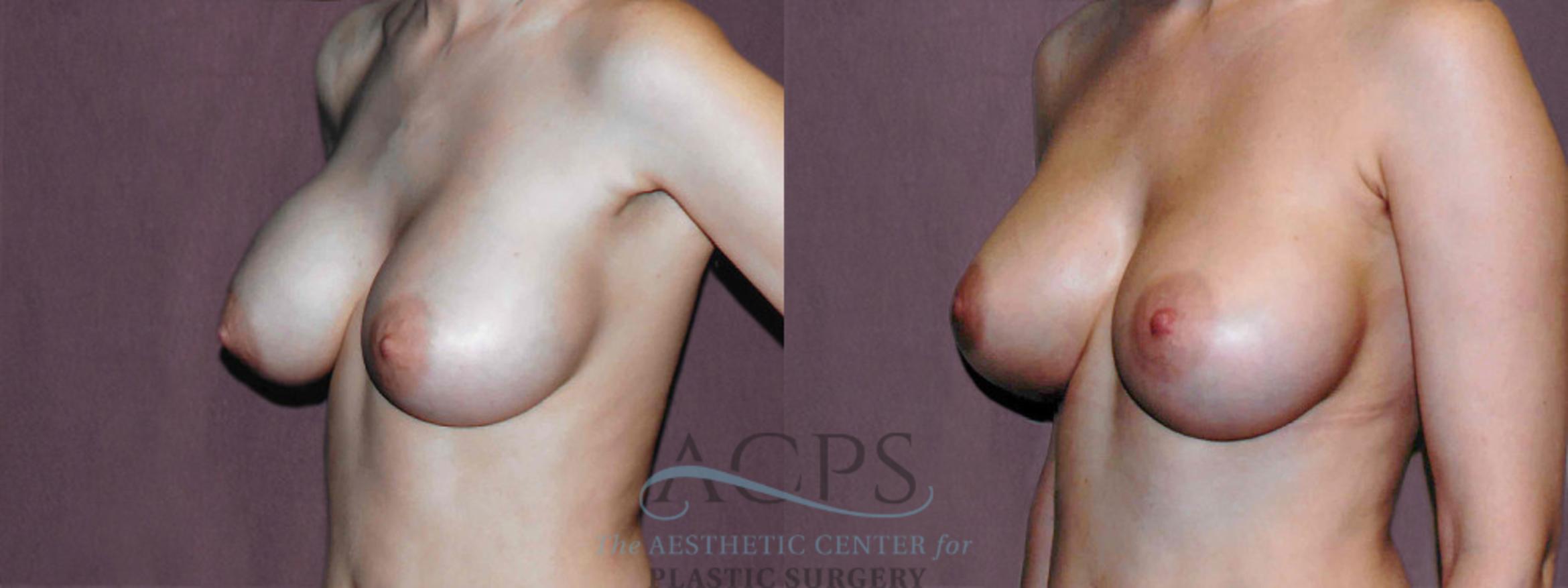 Before & After Breast Revision Case 1070 Oblique Left View: View in Houston, TX