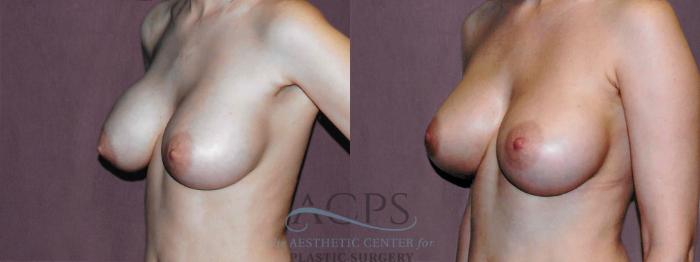 Before & After Breast Revision Case 1070 Oblique Left View: View in Houston, TX