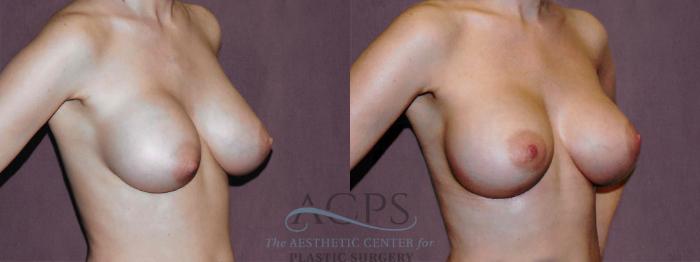 Before & After Breast Revision Case 1070 Oblique Right View: View in Houston, TX