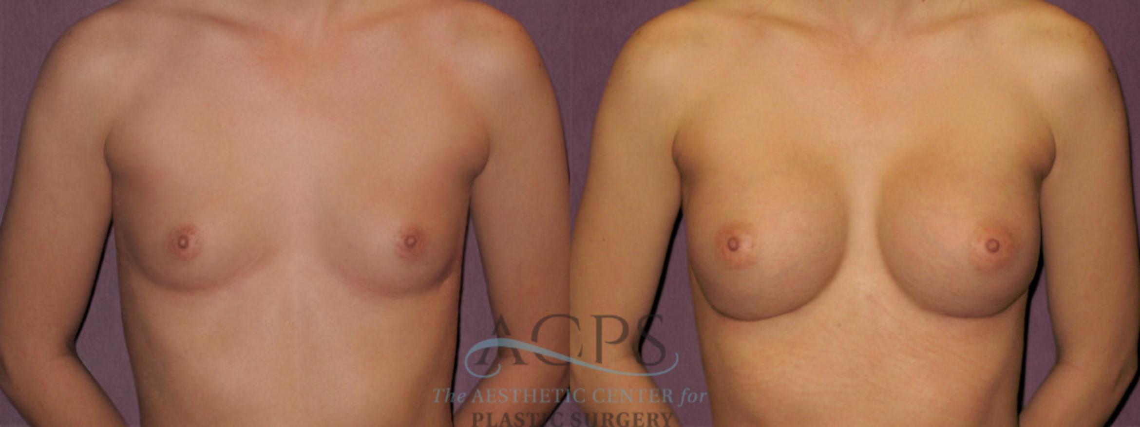 Before & After Breast Revision Case 1071 Front View: View in Houston, TX