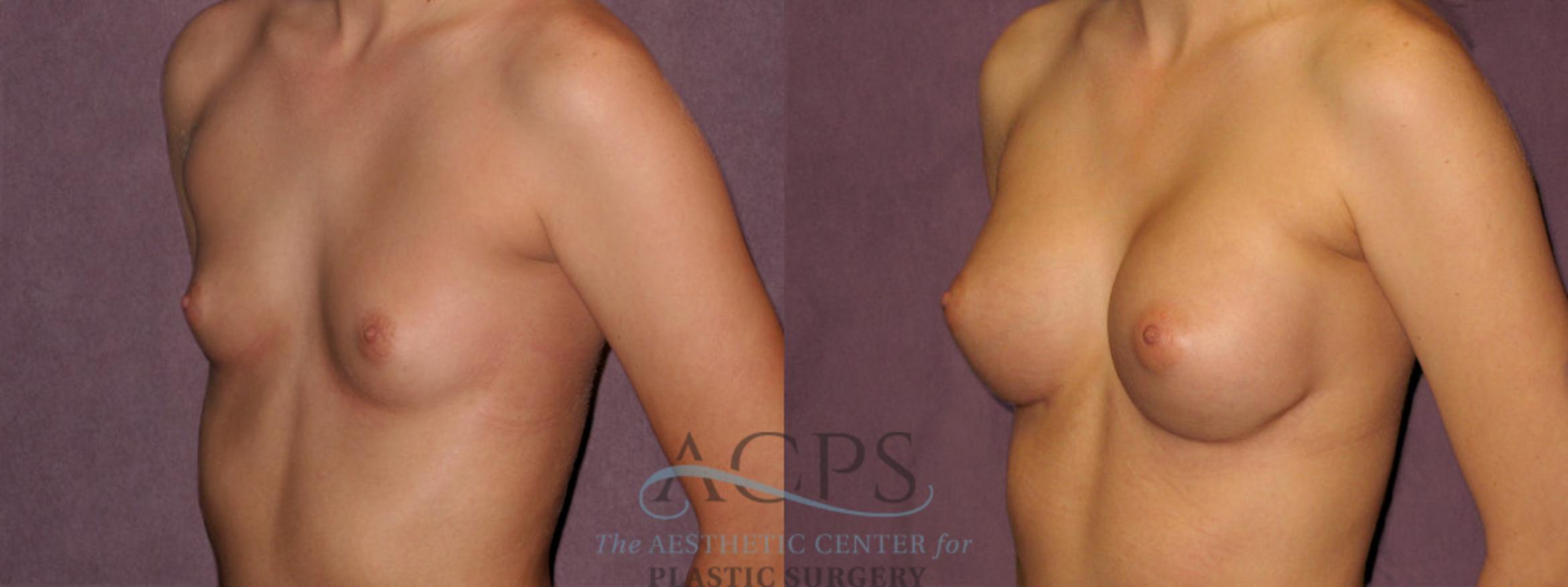 Before & After Breast Revision Case 1071 Oblique Left View: View in Houston, TX