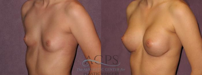 Before & After Breast Revision Case 1071 Oblique Left View: View in Houston, TX