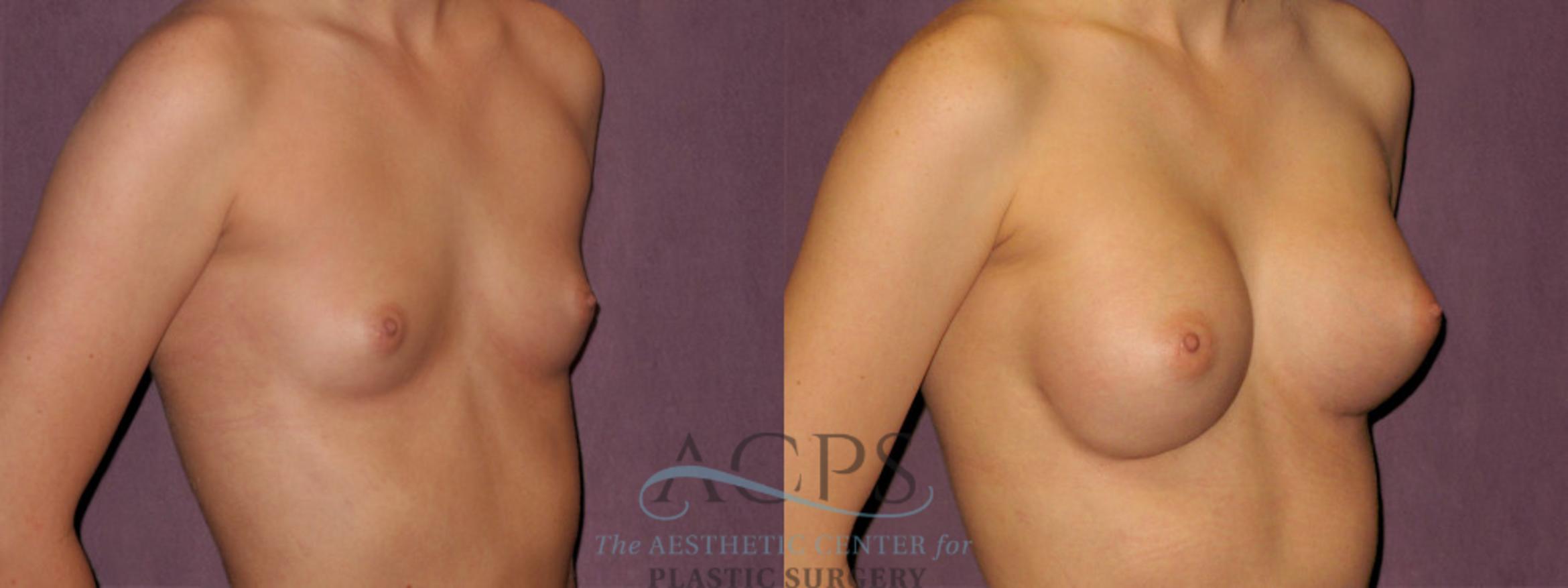 Before & After Breast Revision Case 1071 Oblique Right View: View in Houston, TX