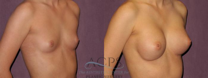 Before & After Breast Revision Case 1071 Oblique Right View: View in Houston, TX