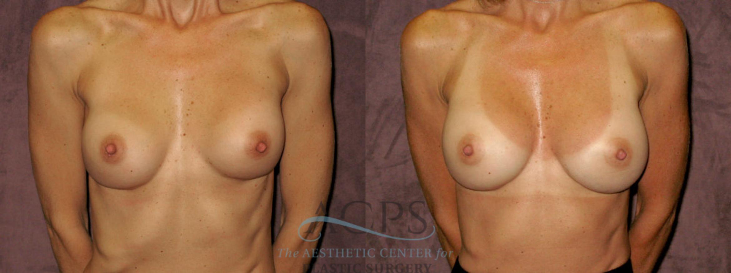 Before & After Breast Revision Case 1072 Front View: View in Houston, TX