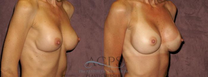 Before & After Breast Revision Case 1072 Oblique Right View: View in Houston, TX