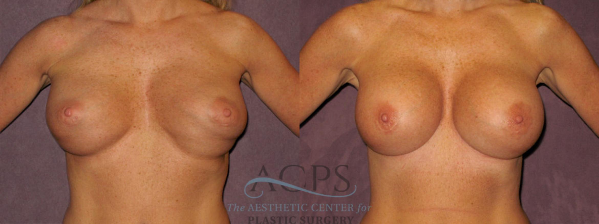 Before & After Breast Revision Case 1073 Front View: View in Houston, TX