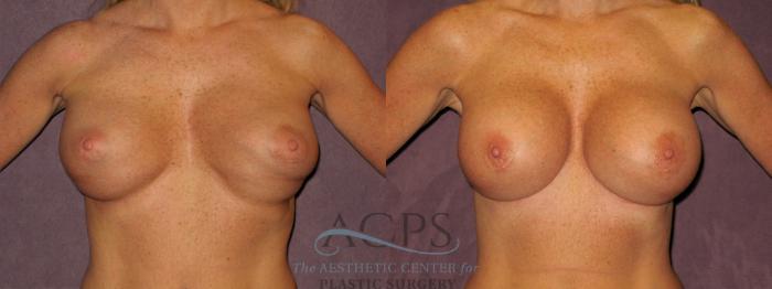 Before & After Breast Revision Case 1073 Front View: View in Houston, TX