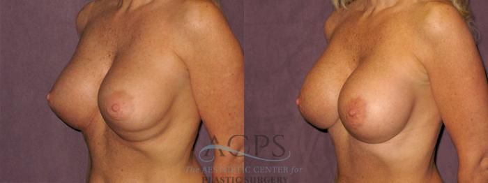 Before & After Breast Revision Case 1073 Oblique Left View: View in Houston, TX