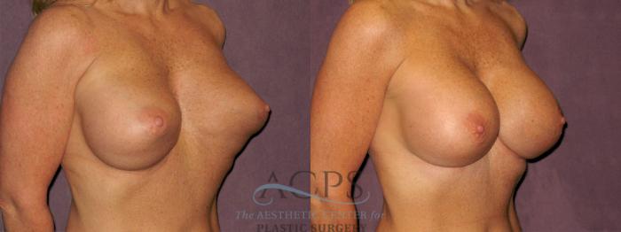 Before & After Breast Revision Case 1073 Oblique Right View: View in Houston, TX
