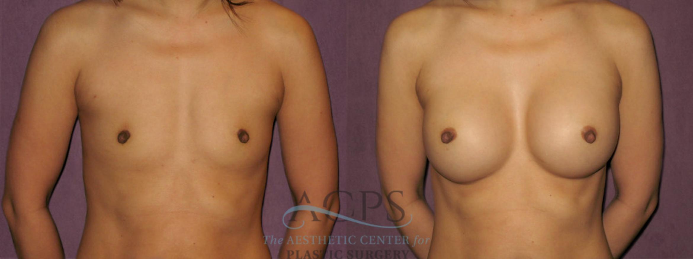 Before & After Breast Revision Case 1074 Front View: View in Houston, TX