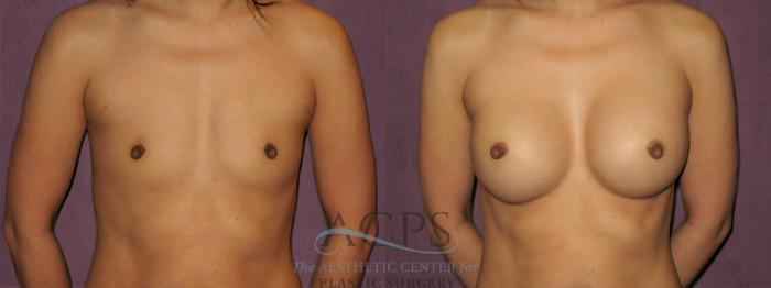 Before & After Breast Revision Case 1074 Front View: View in Houston, TX