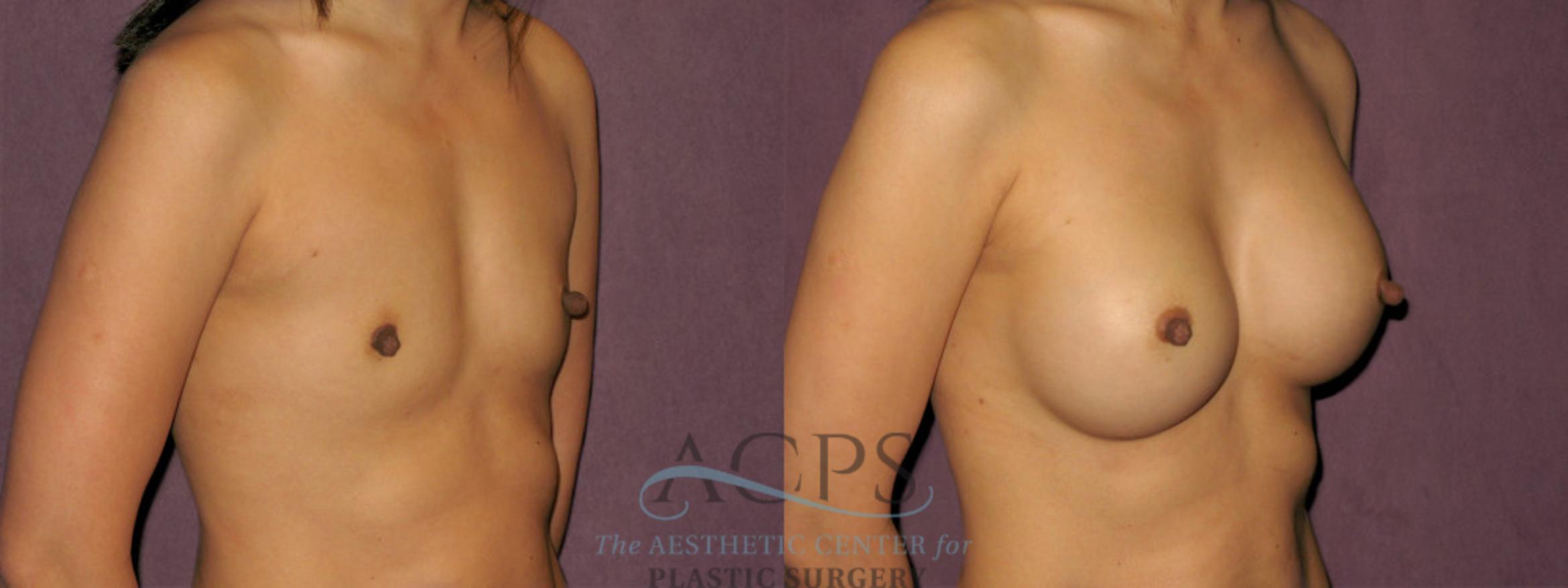 Before & After Breast Revision Case 1074 Oblique Right View: View in Houston, TX