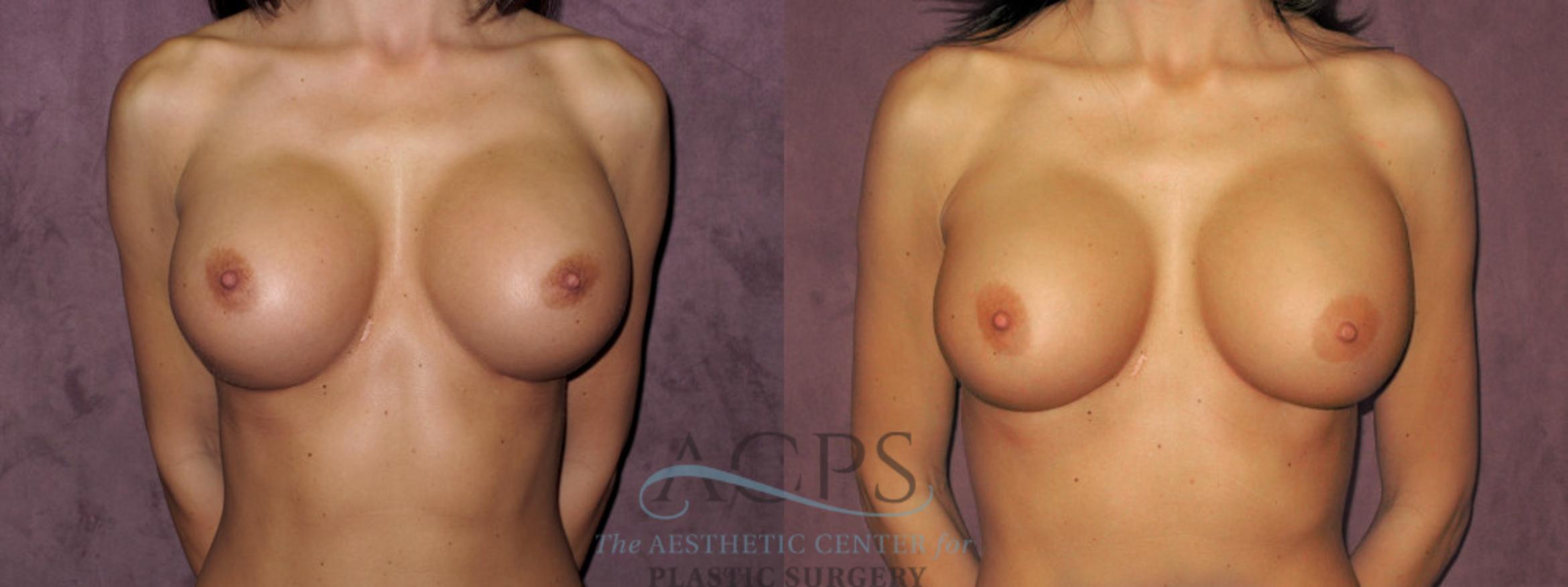 Before & After Breast Revision Case 1075 Front View: View in Houston, TX