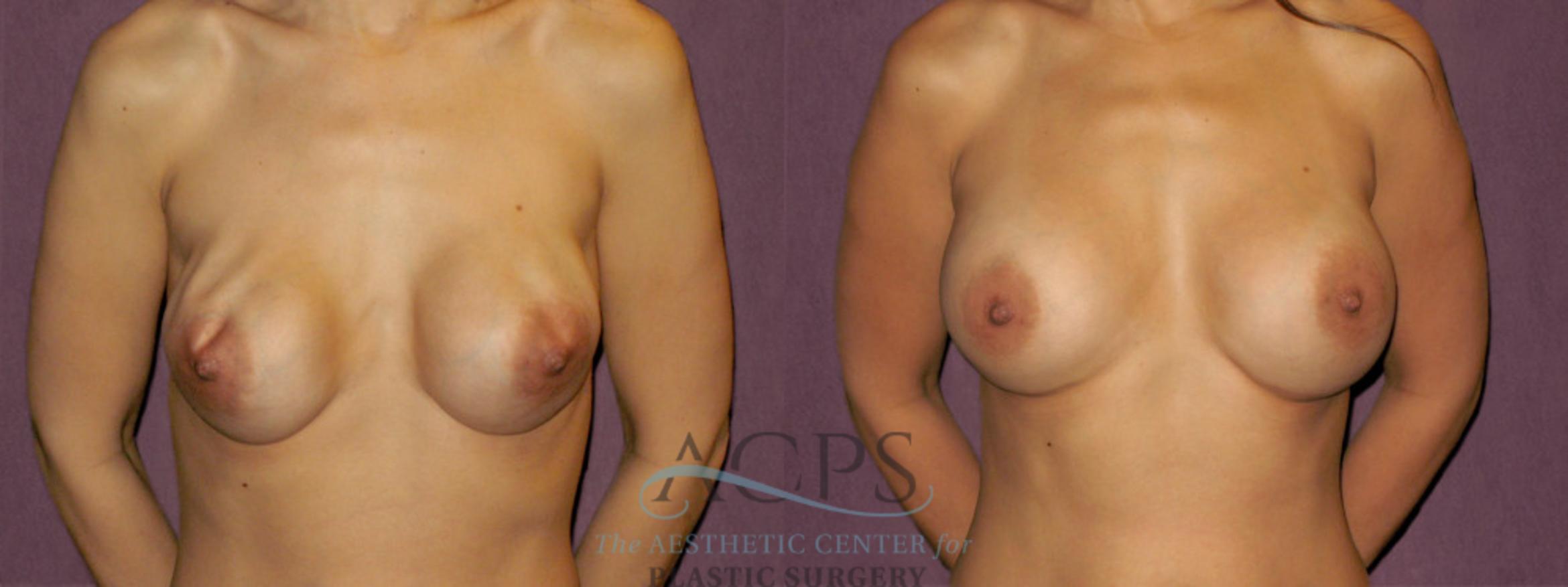 Before & After Breast Revision Case 1076 Front View: View in Houston, TX