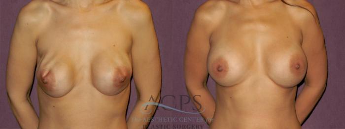 Before & After Breast Revision Case 1076 Front View: View in Houston, TX