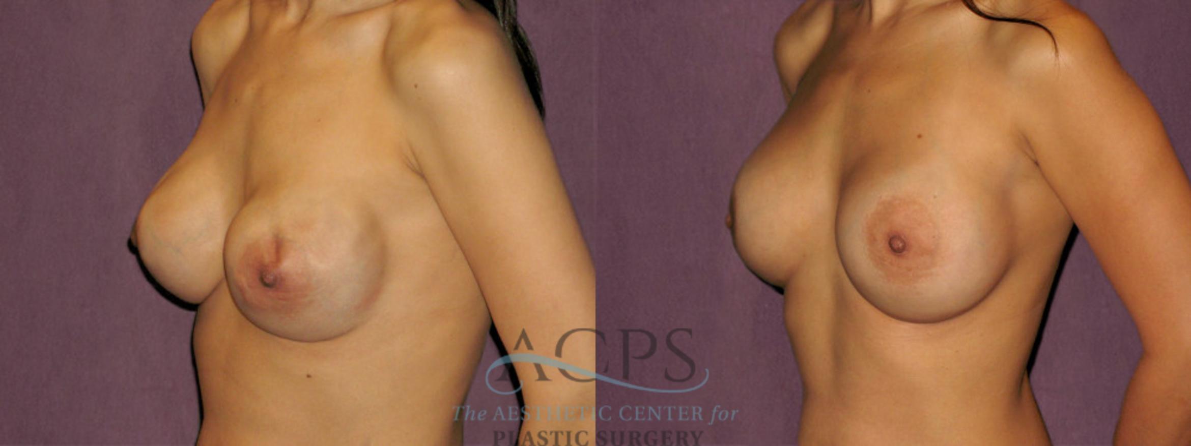 Before & After Breast Revision Case 1076 Oblique Left View: View in Houston, TX