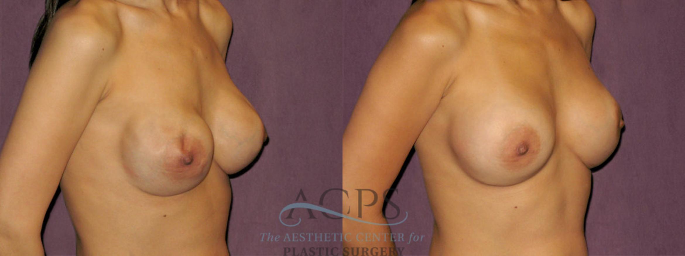 Before & After Breast Revision Case 1076 Oblique Right View: View in Houston, TX