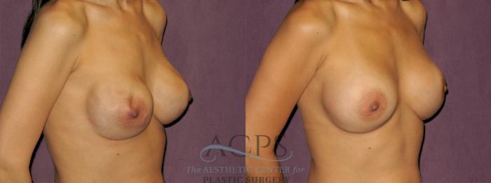 Before & After Breast Revision Case 1076 Oblique Right View: View in Houston, TX