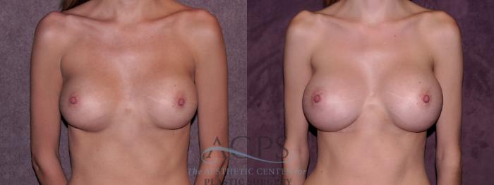 Before & After Breast Revision Case 1077 Front View: View in Houston, TX