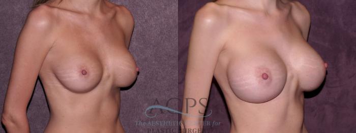 Before & After Breast Revision Case 1077 Oblique Right View: View in Houston, TX