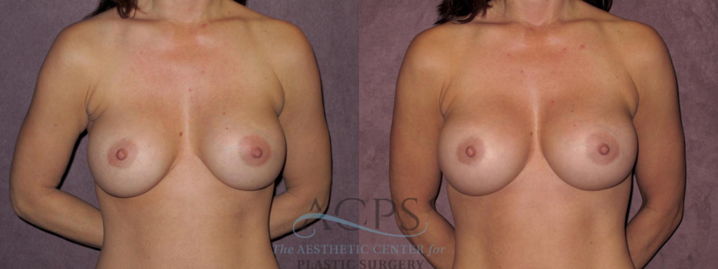 Before & After Breast Revision Case 1078 Front View: View in Houston, TX