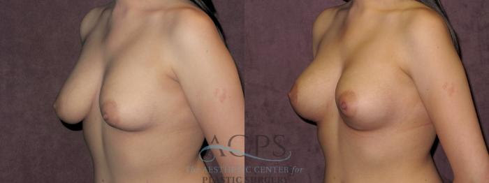 Before & After Breast Revision Case 1080 Oblique Left View: View in Houston, TX