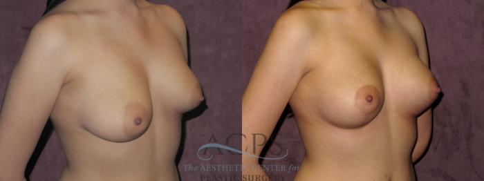 Before & After Breast Revision Case 1080 Oblique Right View: View in Houston, TX