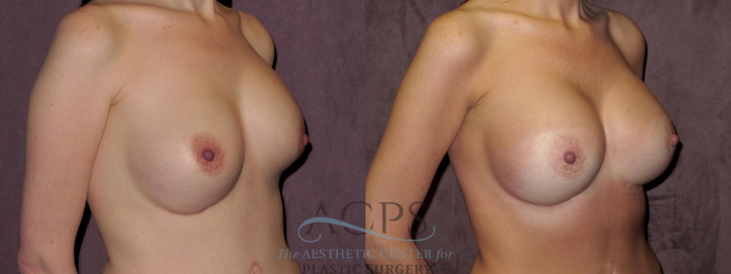 Before & After Breast Revision Case 1081 Oblique Right View: View in Houston, TX