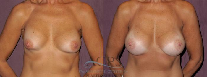 Before & After Breast Revision Case 1082 Front View: View in Houston, TX