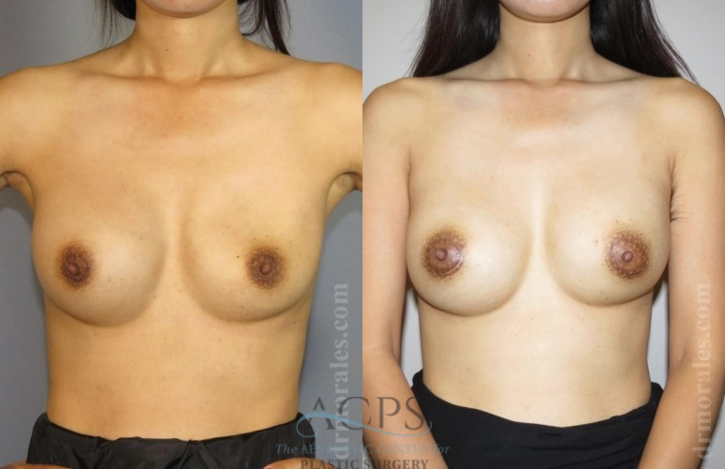 Before & After Breast Revision Case 1090 Front View: View in Houston, TX