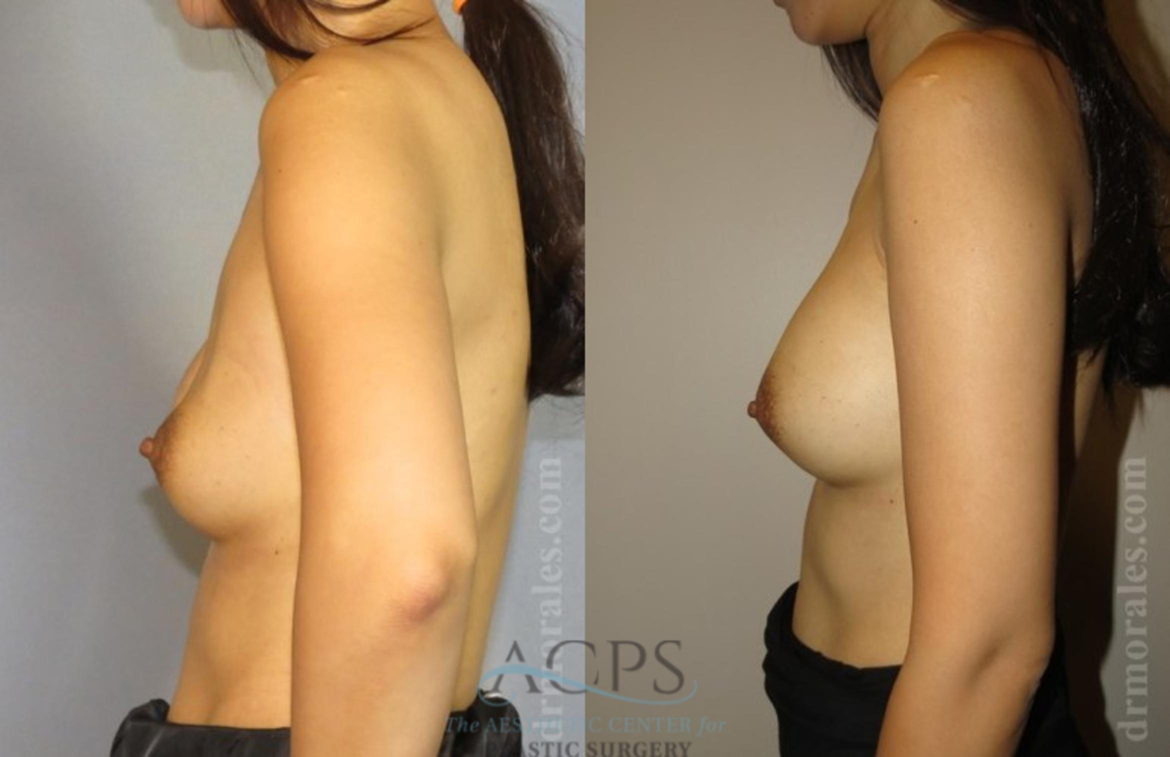 Before & After Breast Revision Case 1090 Side View: View in Houston, TX