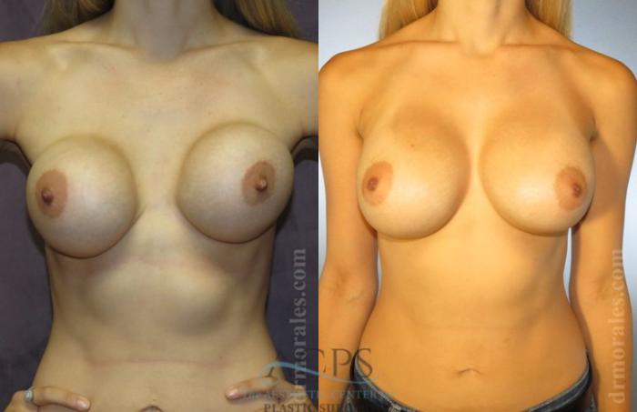 Before & After Breast Revision Case 1091 Front View: View in Houston, TX