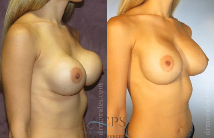 Before & After Breast Revision Case 1091 Oblique View: View in Houston, TX