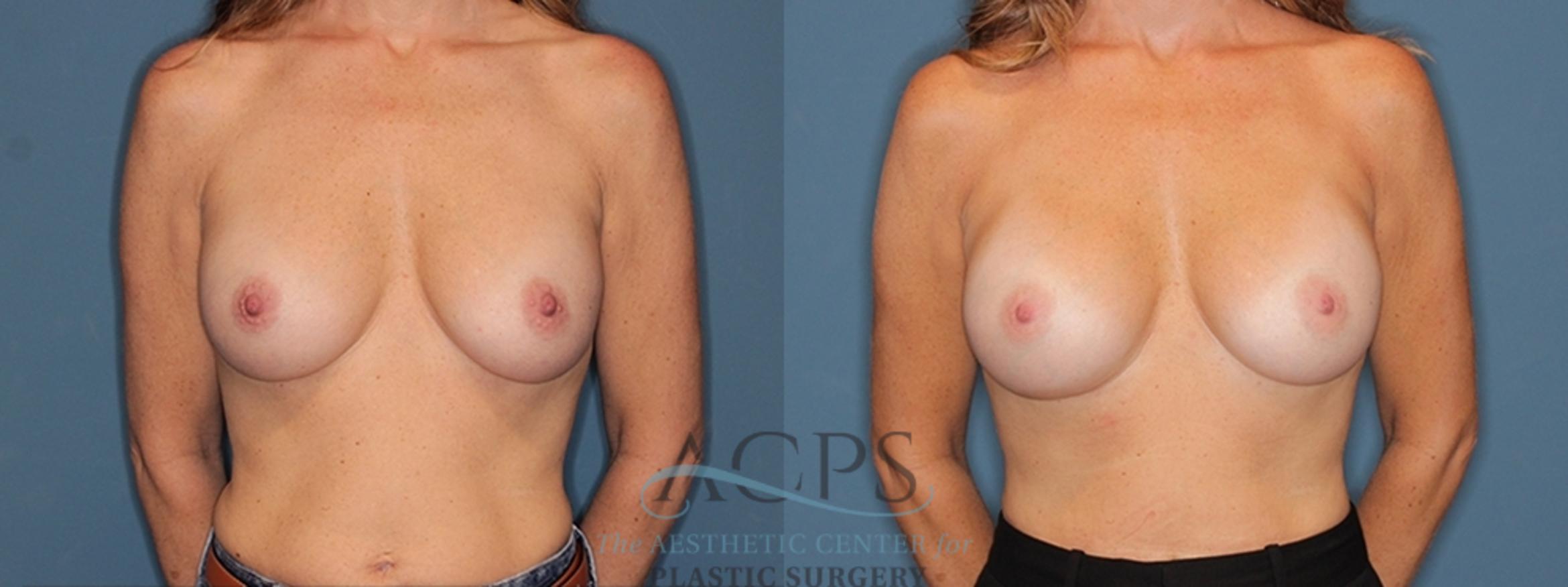 Before & After Breast Revision Case 1546 Front View in Houston, TX