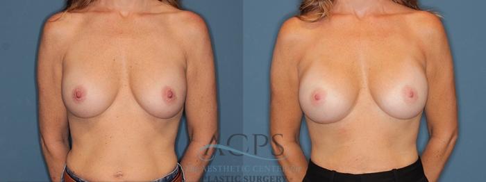 Before & After Breast Revision Case 1546 Front View in Houston, TX