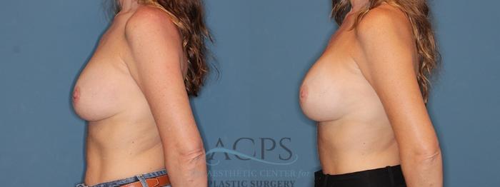 Before & After Breast Revision Case 1546 Right Oblique View in Houston, TX