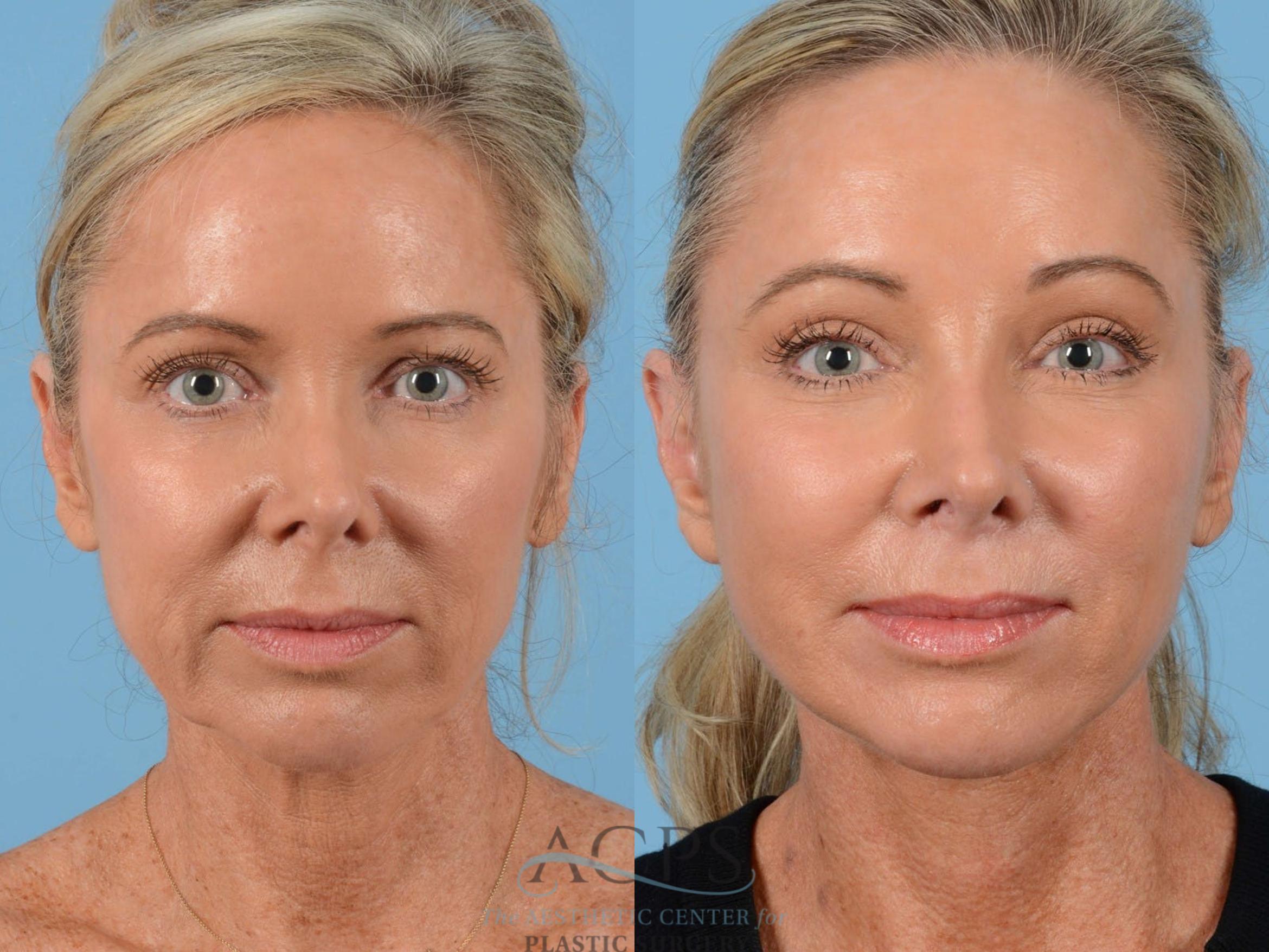 Before & After Brow Lift Case 1350 Front View: View in Houston, TX