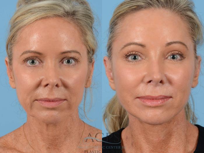Before & After Brow Lift Case 1350 Front View: View in Houston, TX