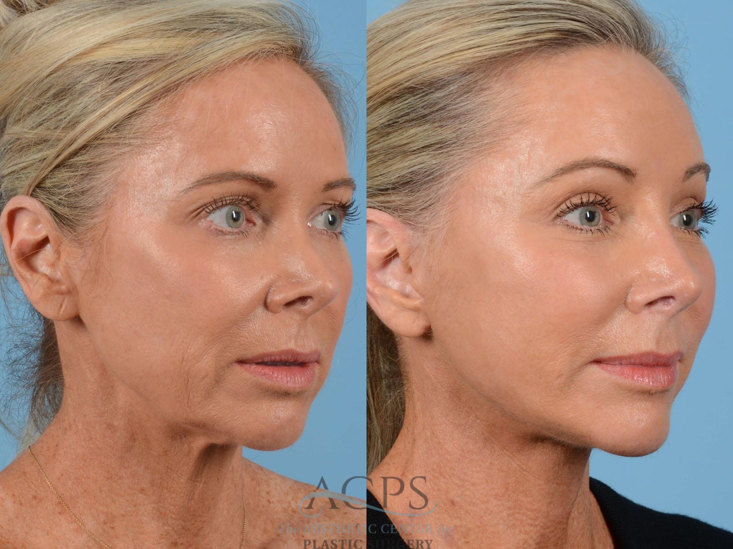 Before & After Brow Lift Case 1350 Oblique View: View in Houston, TX