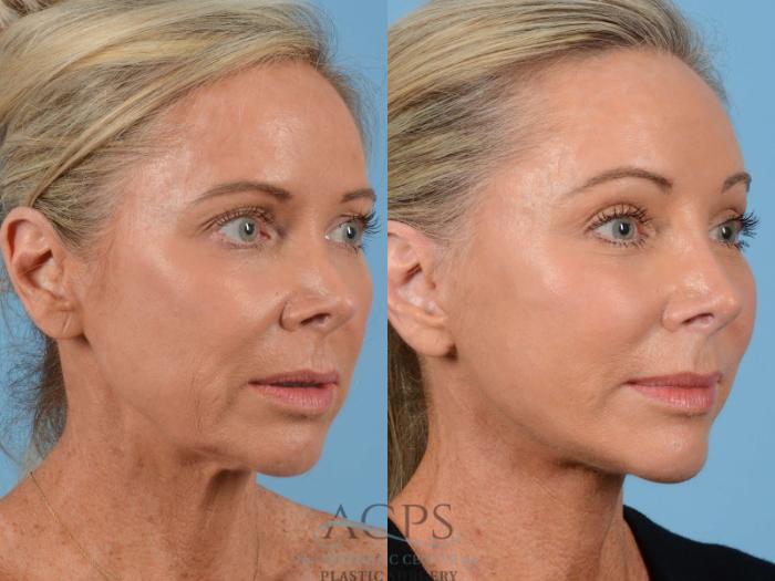 Before & After Brow Lift Case 1350 Oblique View: View in Houston, TX
