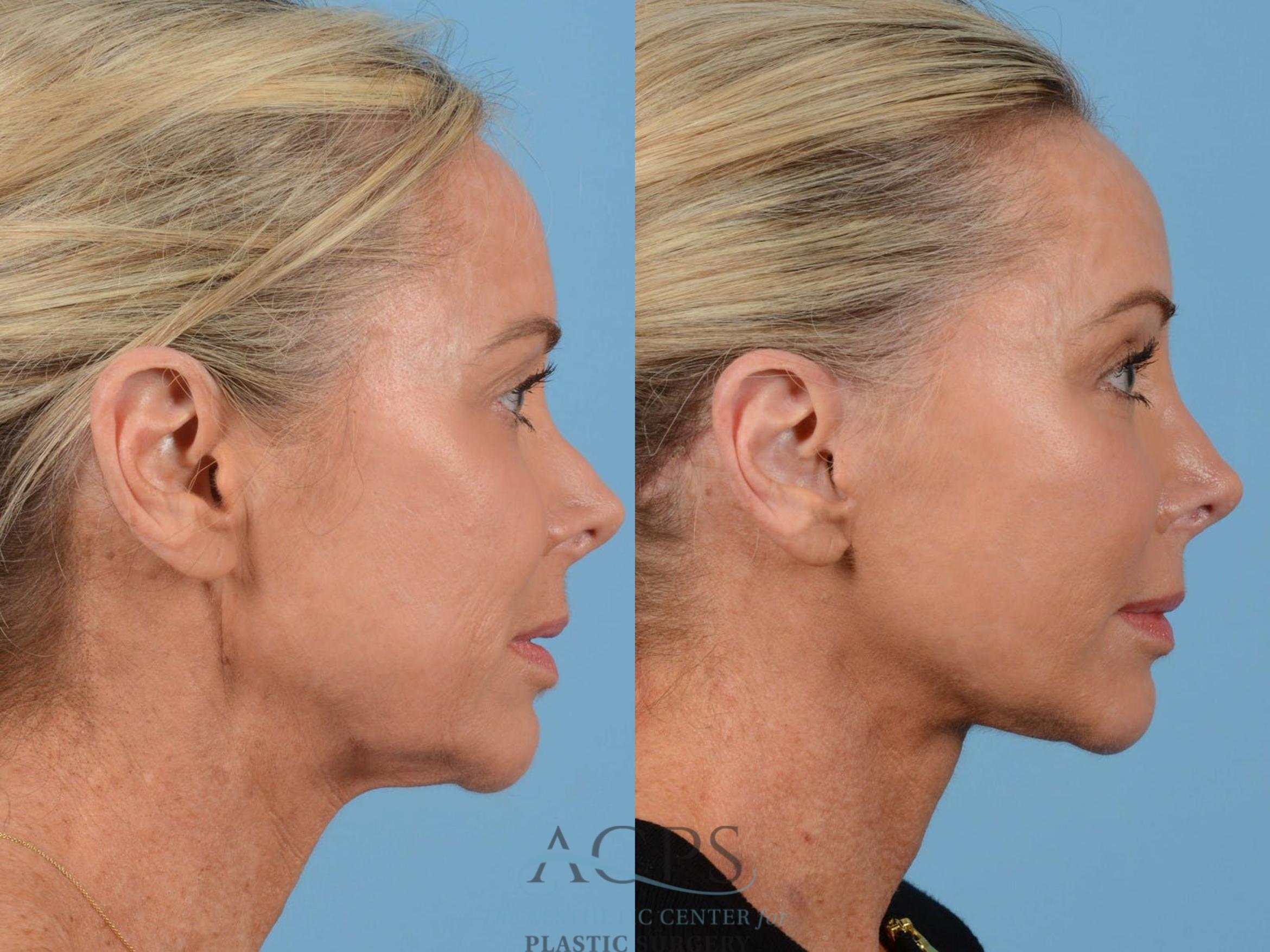 Before & After Brow Lift Case 1350 Side View: View in Houston, TX